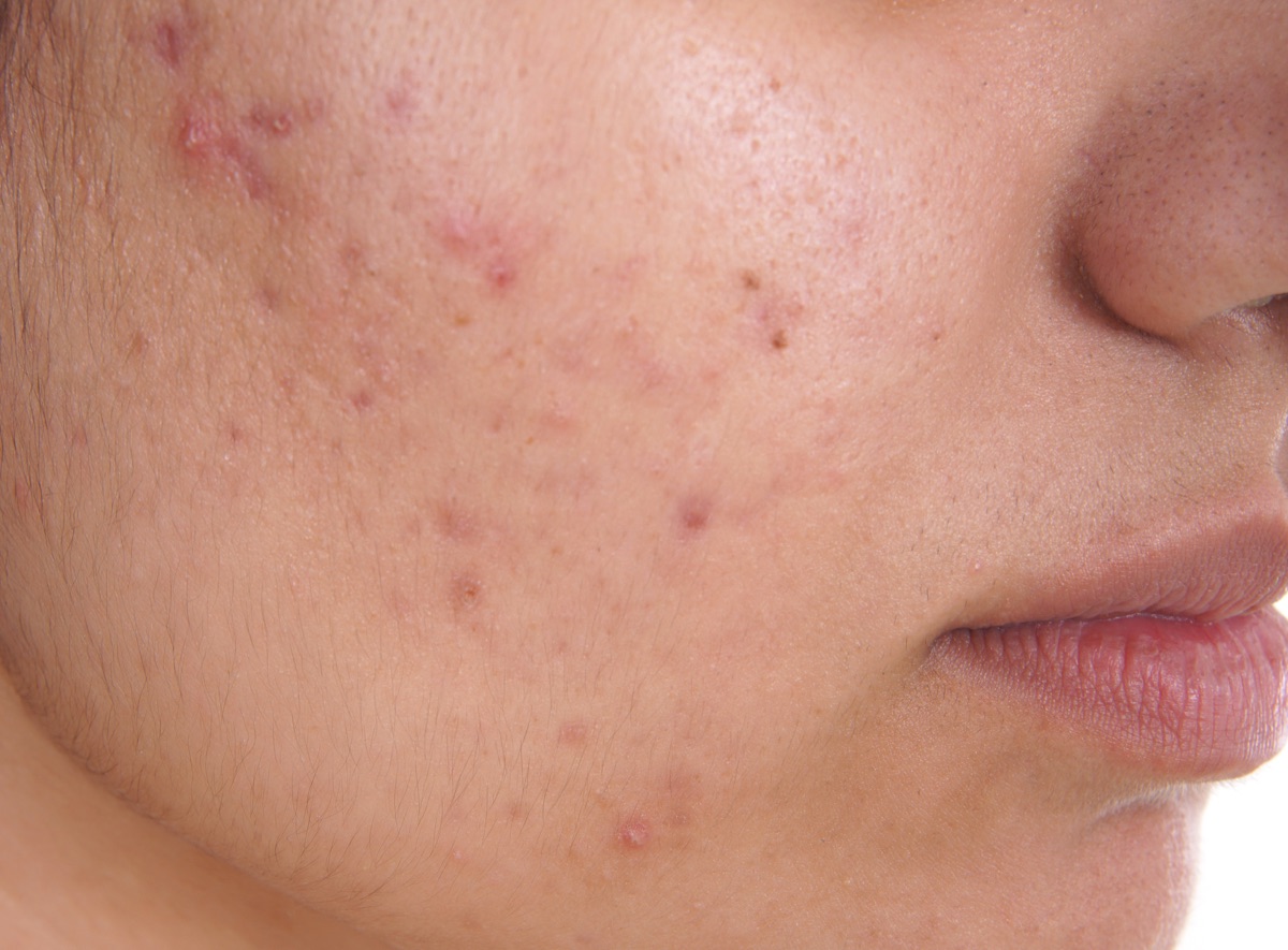 Close-up of skin with acne