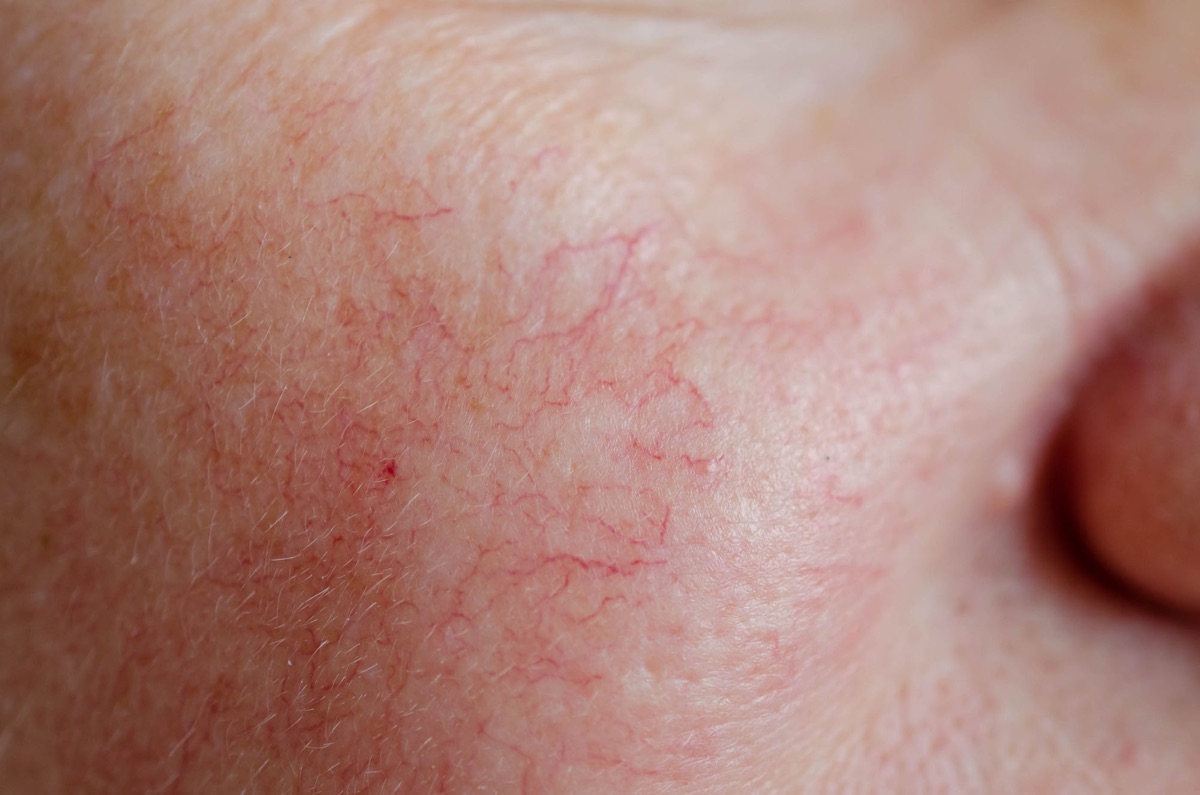 Close-up of skin with rosacea and facial redness